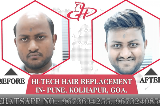 non surgical hair replacement in pune