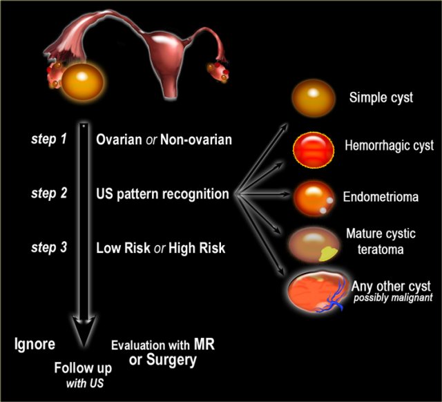 ovarian cyst size chart