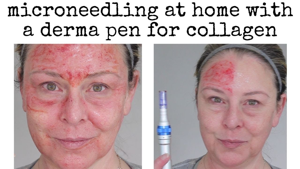 microneedling pen at home