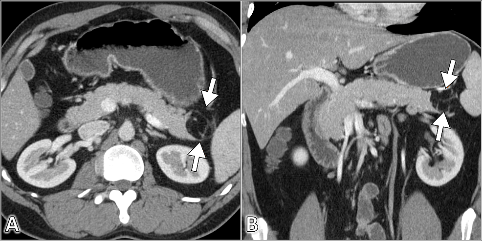 lipoma on pancreas