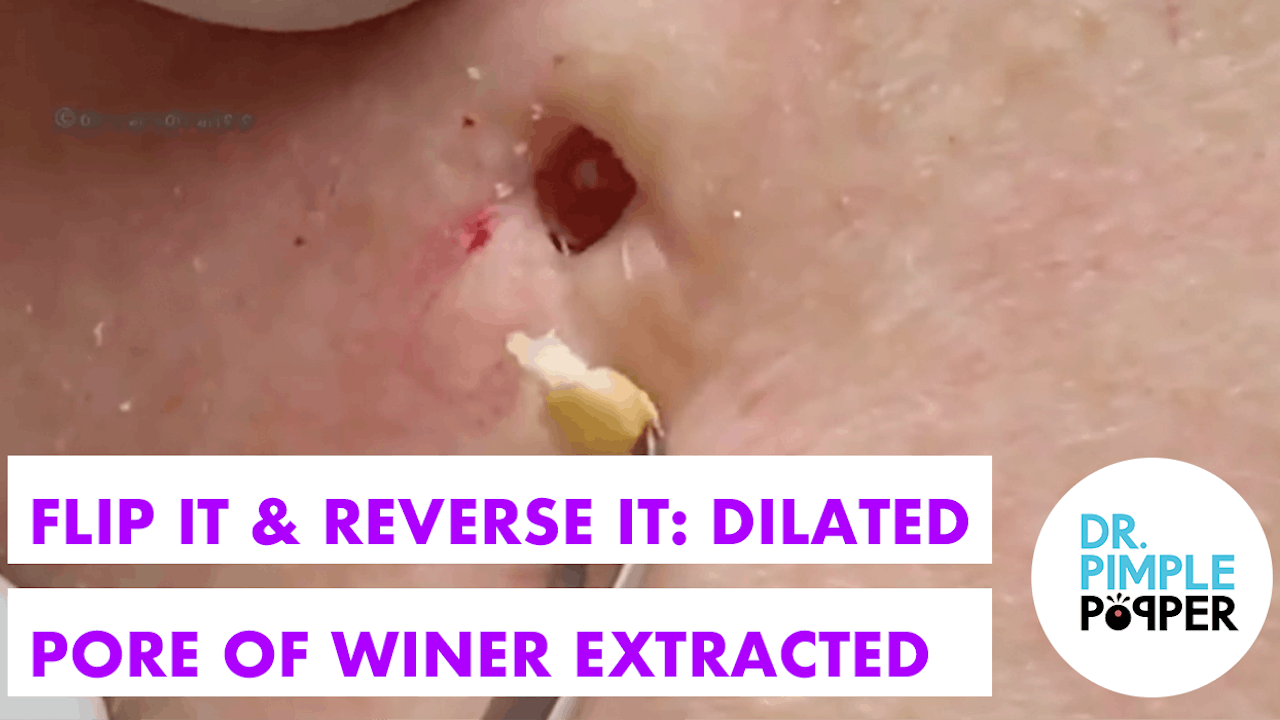 pore winer removal