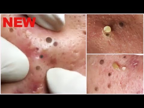 bubuplus blackhead removal 2018