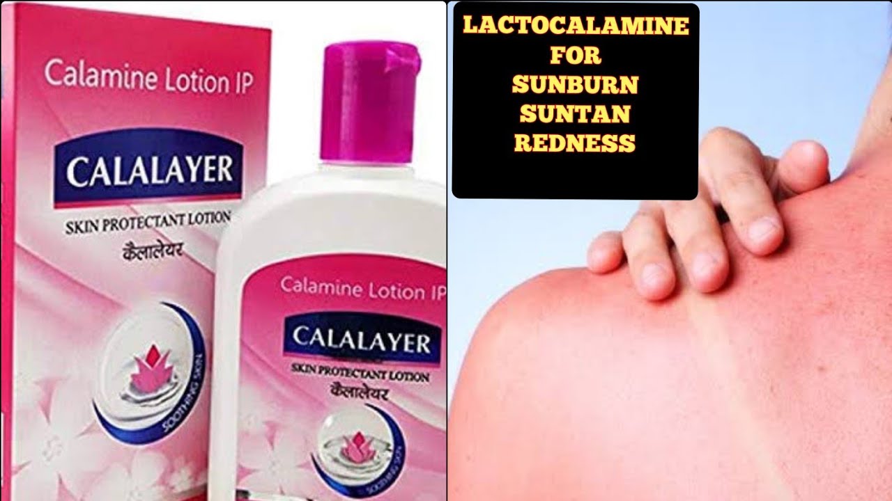 lacto calamine for sunburn