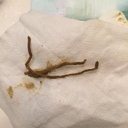 fiber strings in poop pictures