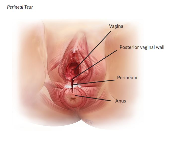 3rd degree perineal tear pictures