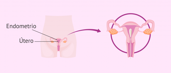 ablación endometrial opiniones