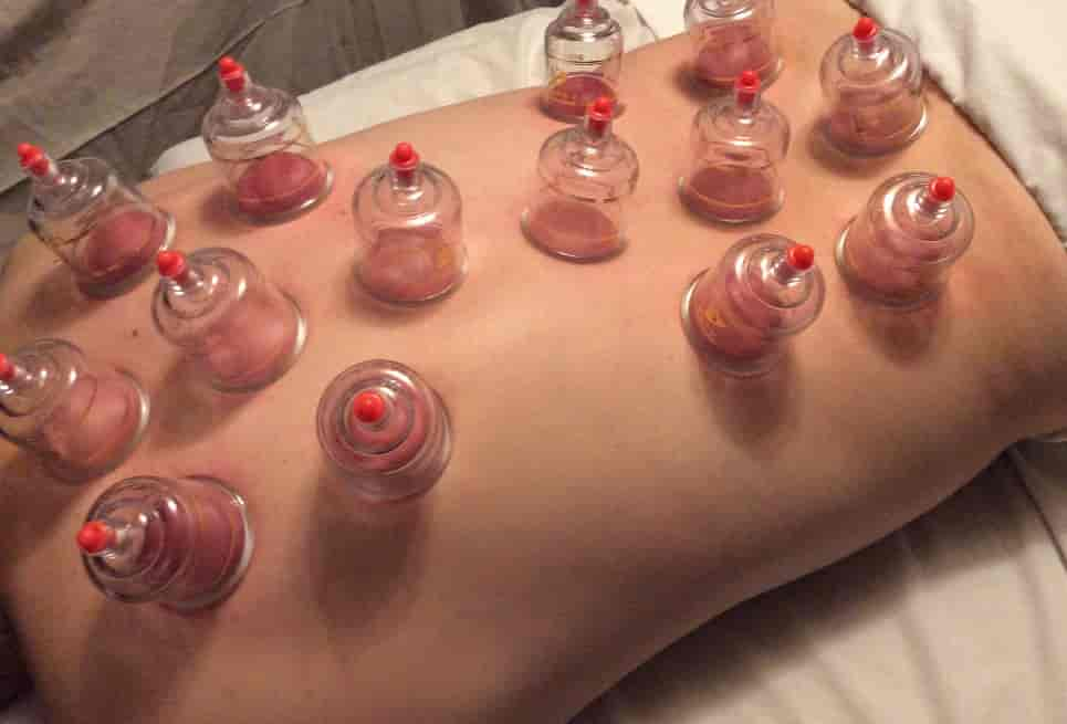 cupping therapy in ahmedabad