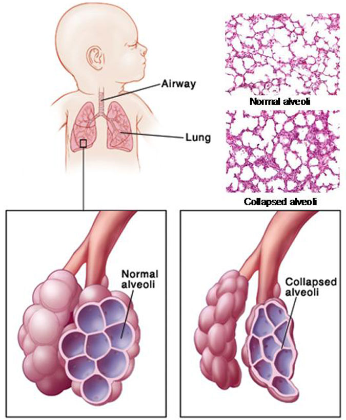 what is pulmonary surfactant