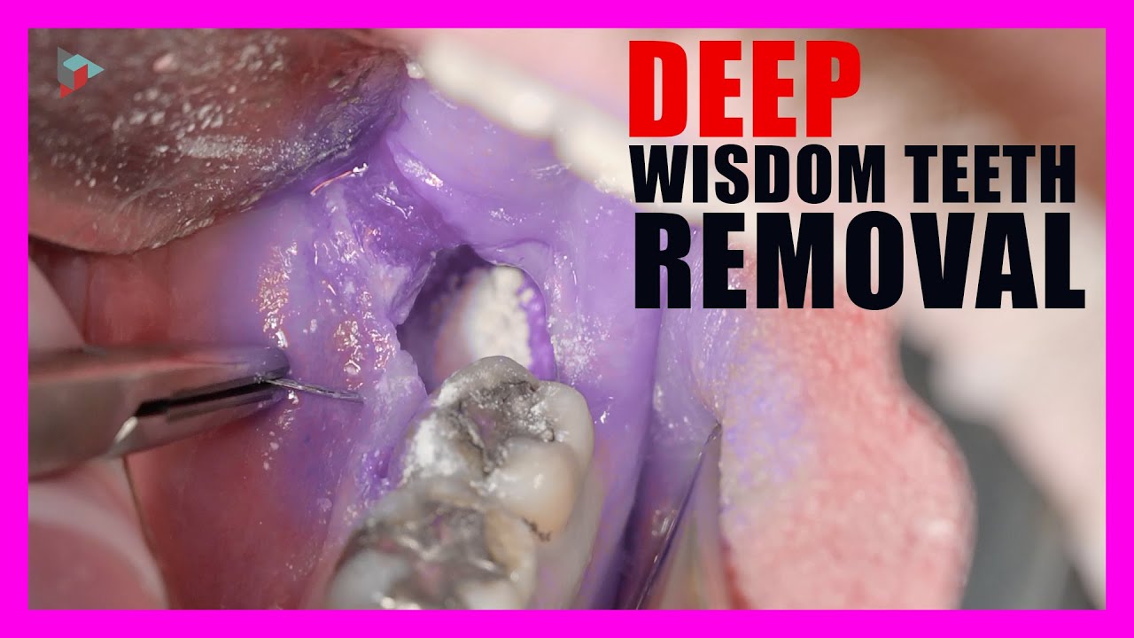 wisdom teeth removal youtube