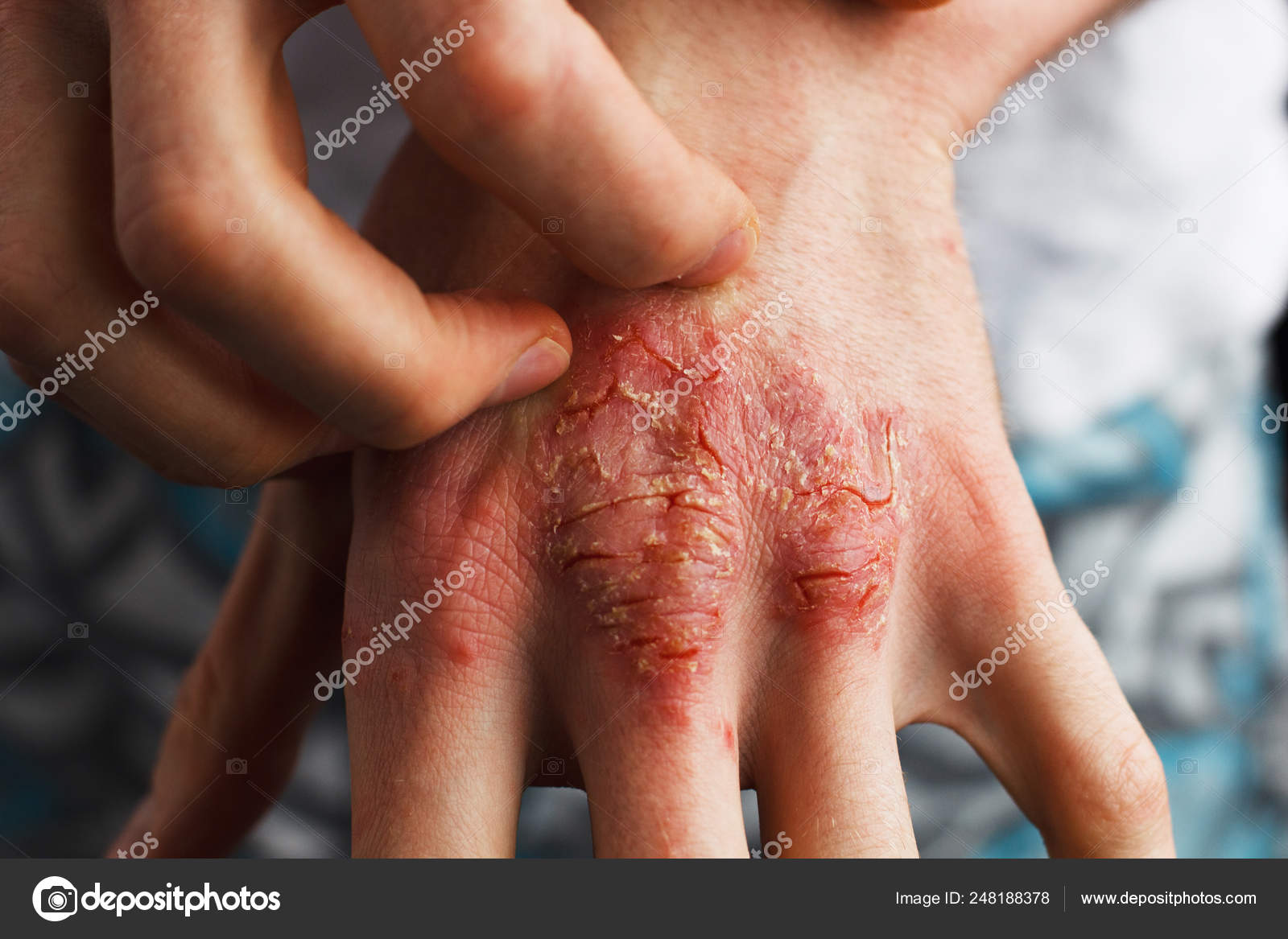 vulgar eczema