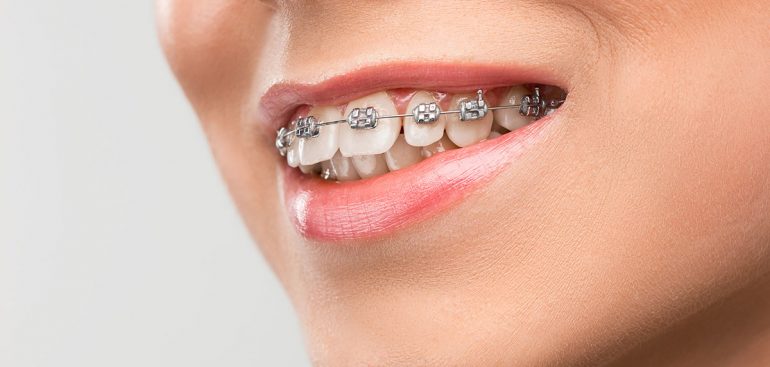 invisalign konya