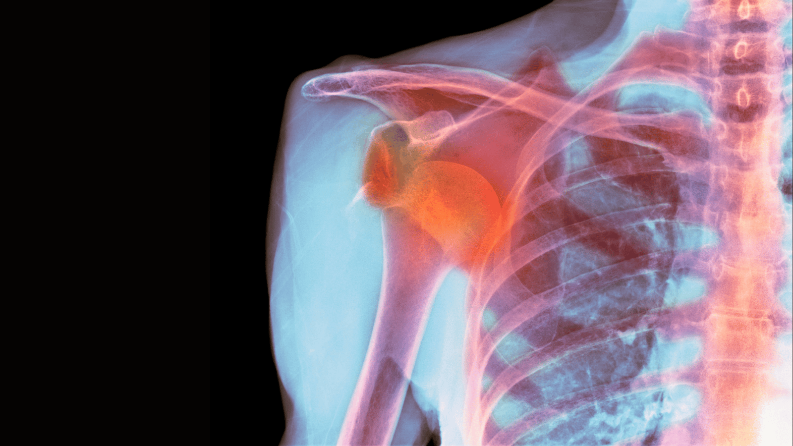 right shoulder dislocation icd 10