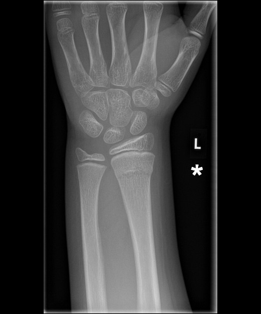 distal radius fracture radiopaedia