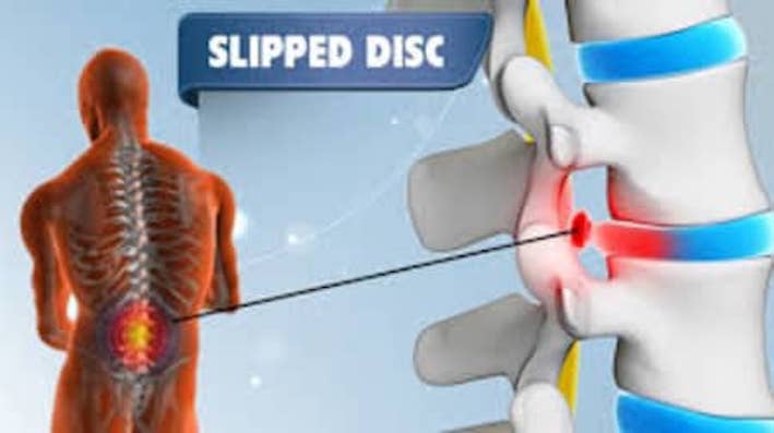 slippedisc