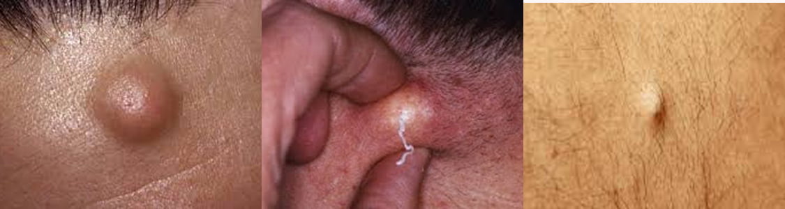 sebaceous cyst removal sydney