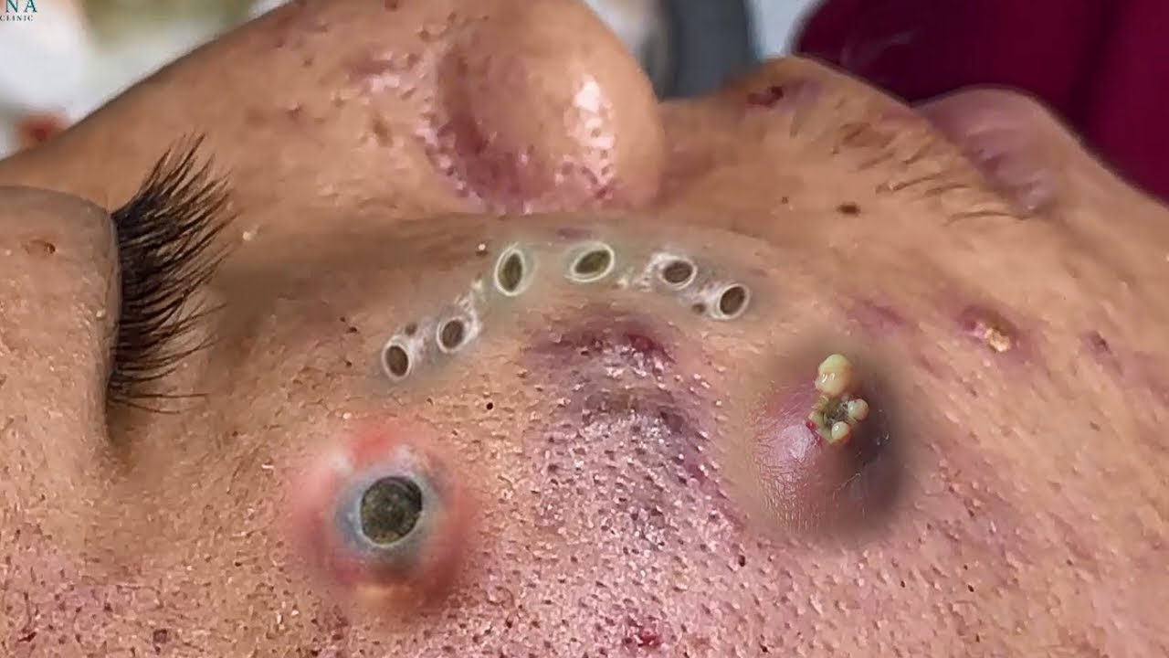 severe cystic acne popping