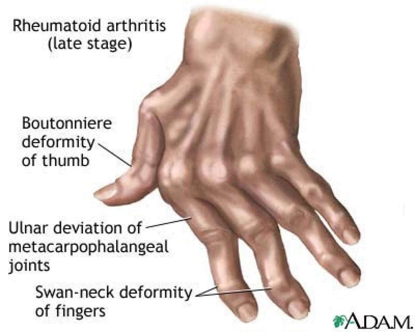 arthritis ne demek