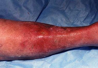 right lower extremity cellulitis icd 10