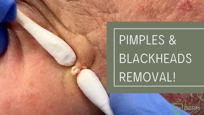 dr derm videos of squeezing blackheads