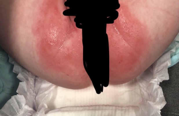 chemical burn from huggies