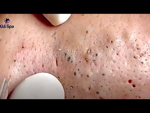 new blackheads today