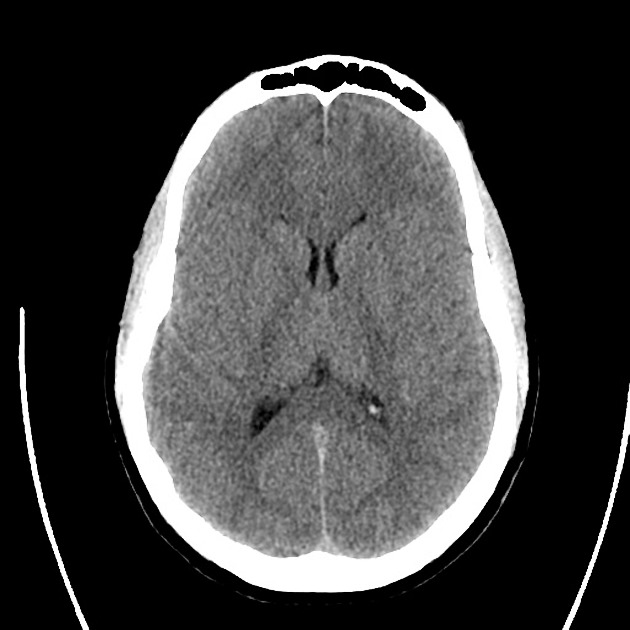 cerebellopontine angle cyst