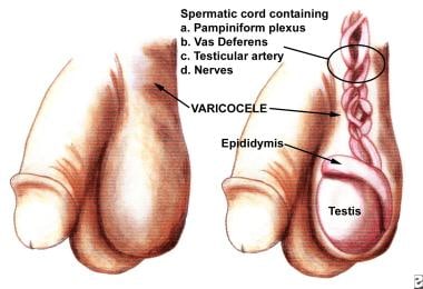 varicocele fotos reales