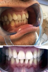 dr smile aligner