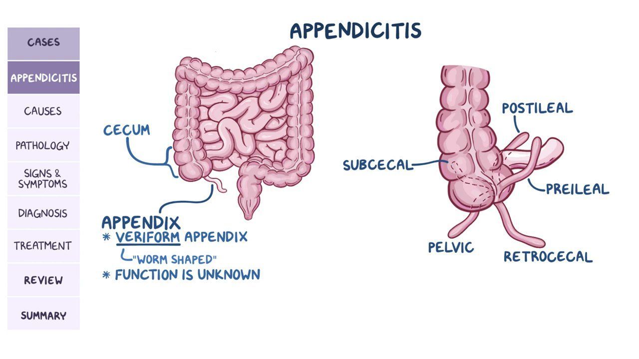 epiploic appendagitis icd 10