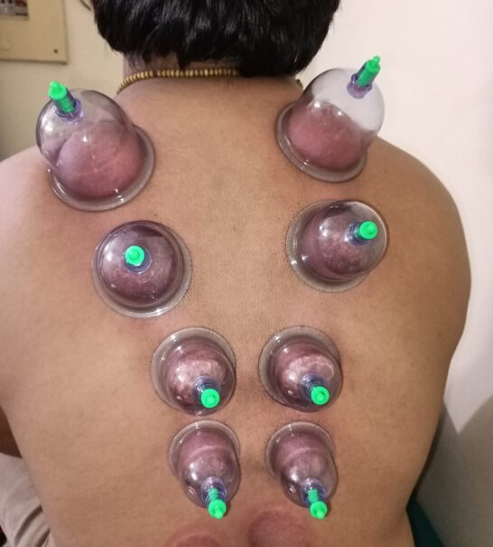 hijama near me