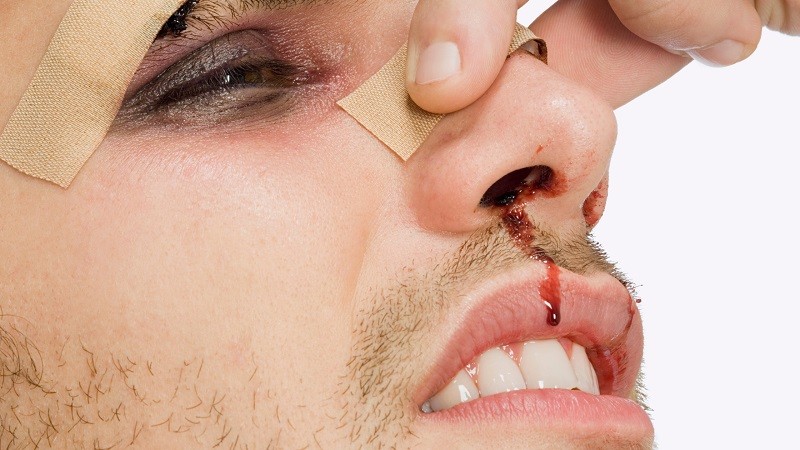 bleeding from the nose following head trauma emt