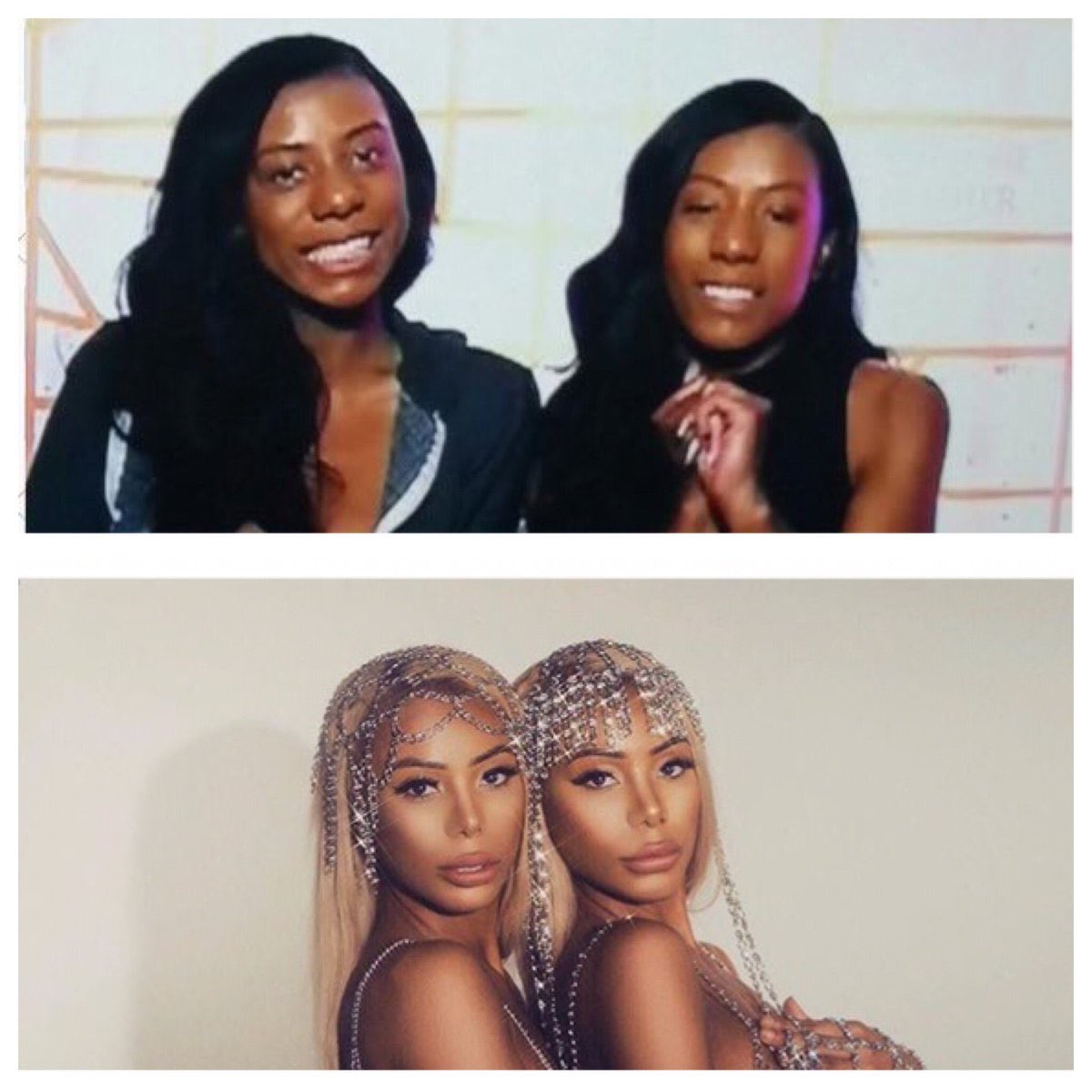 clermont twins before and after surgery