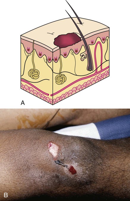 abrasion of right knee icd 10