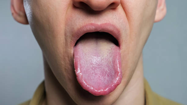 unhealthy tongue pics