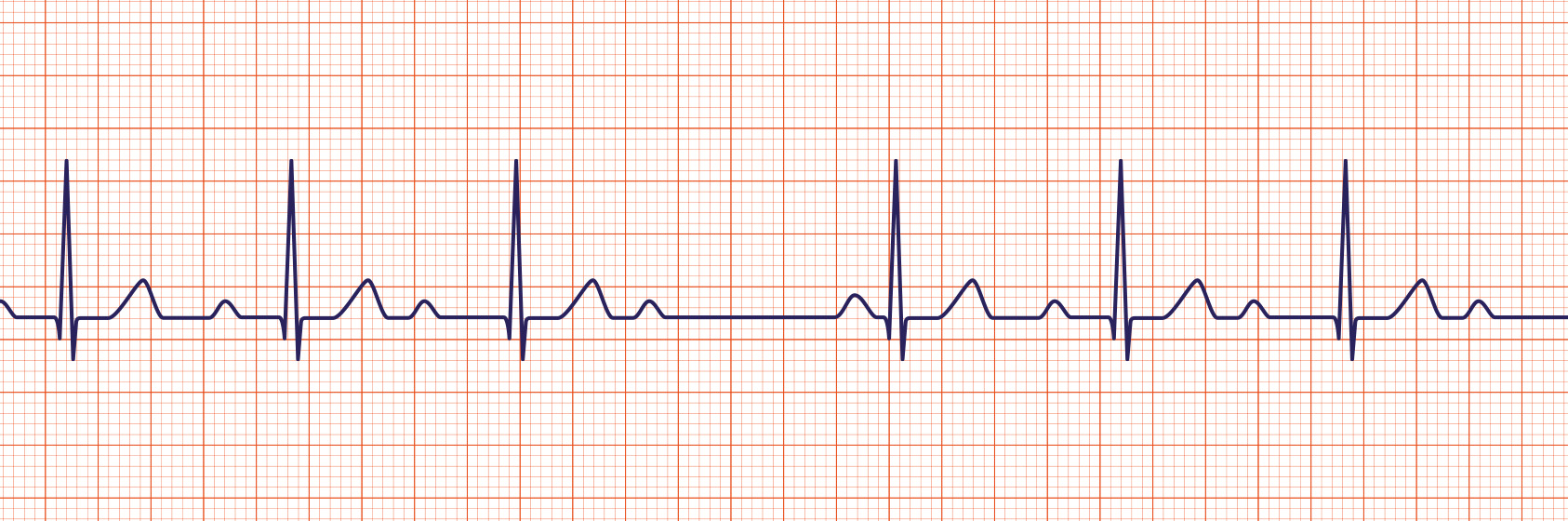 acls ecg rhythms