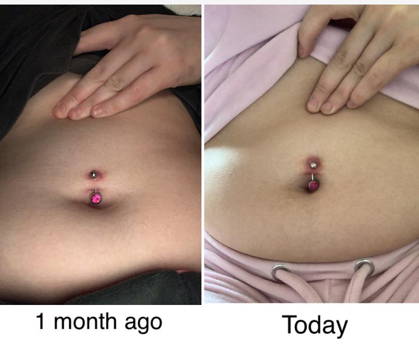 belly button rejection