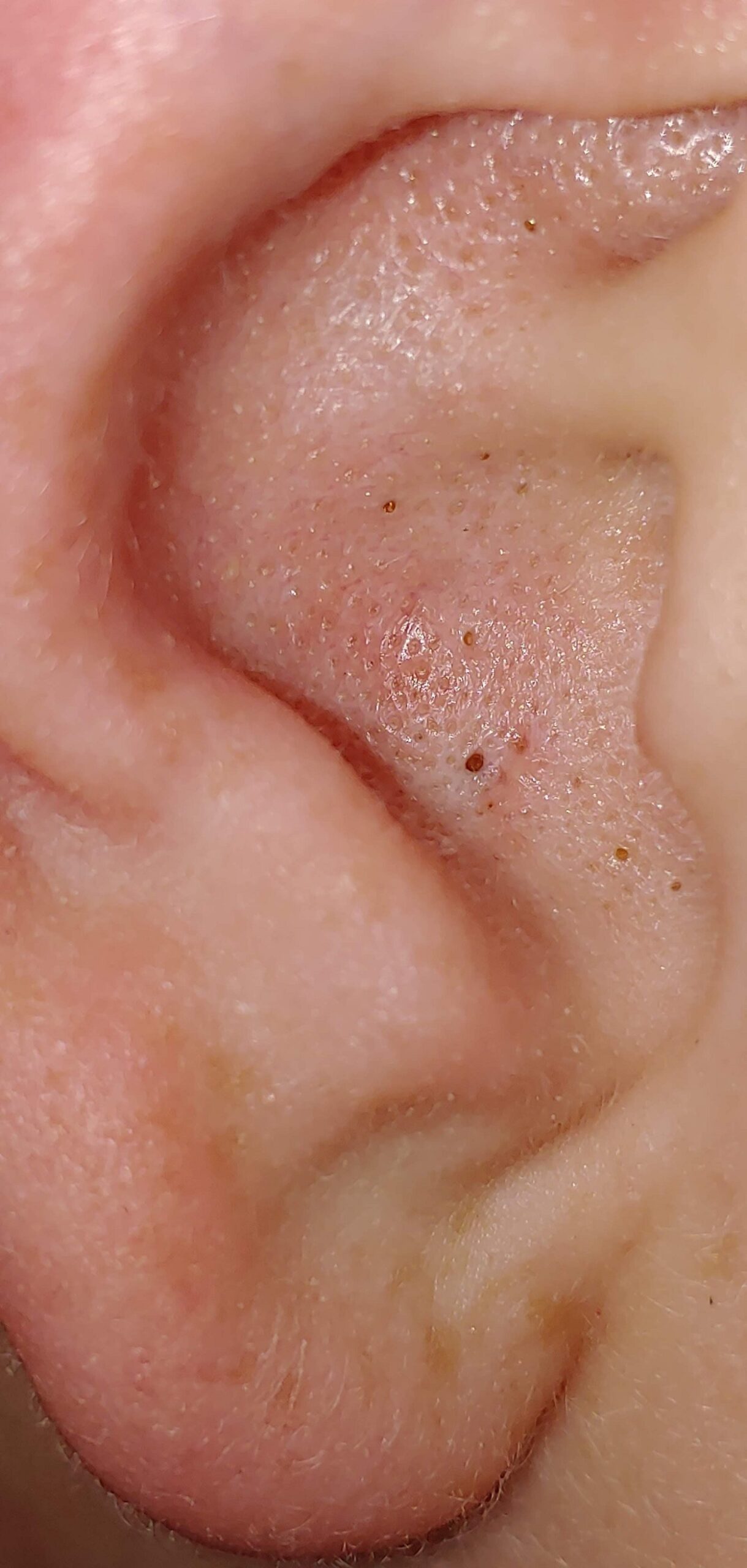 blackheads inside ear