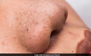 show me blackheads