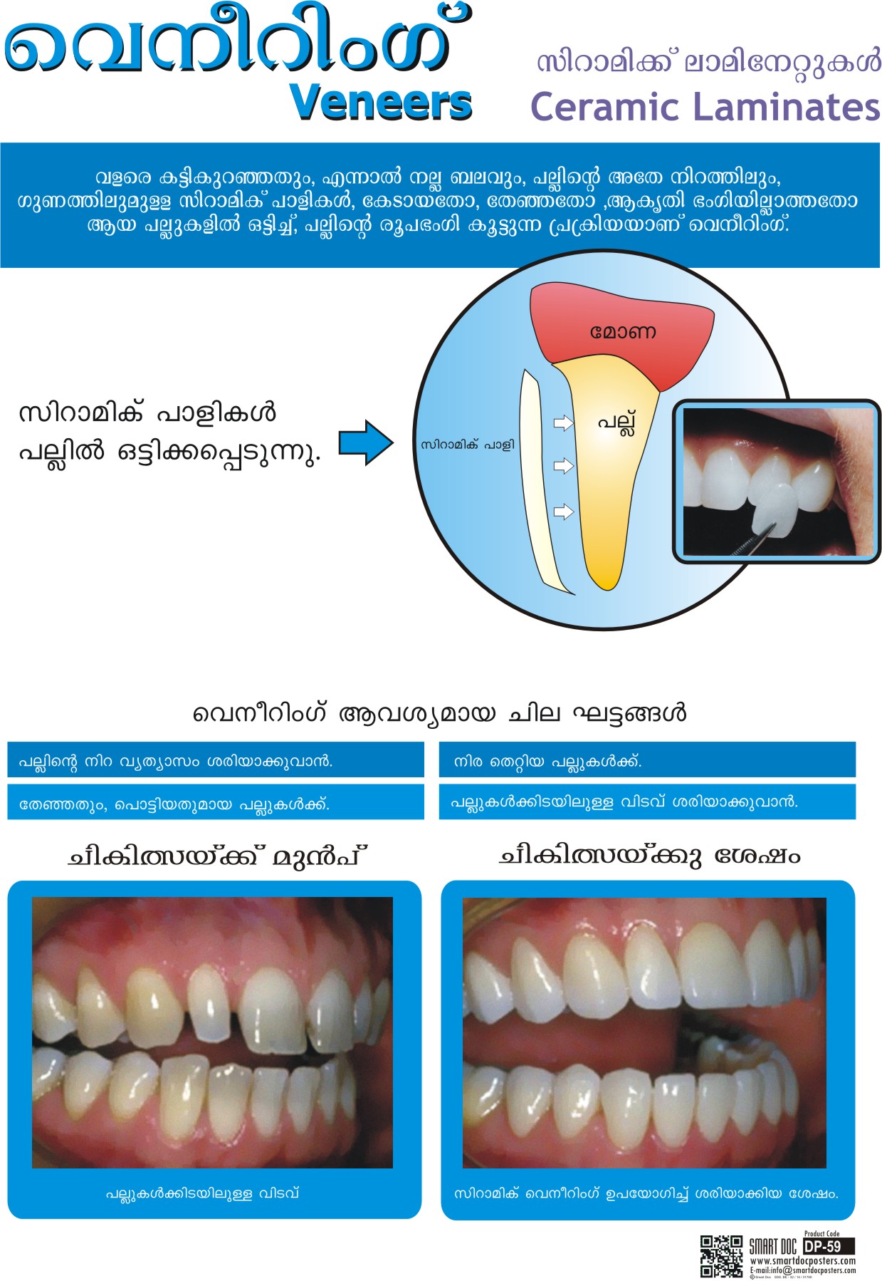 veneer meaning in malayalam