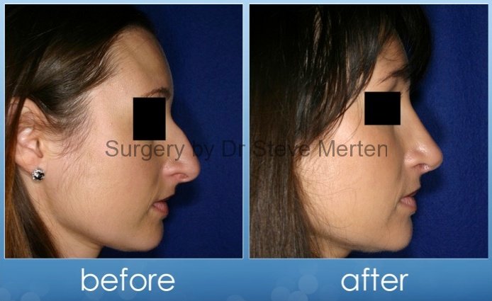 cheap rhinoplasty australia