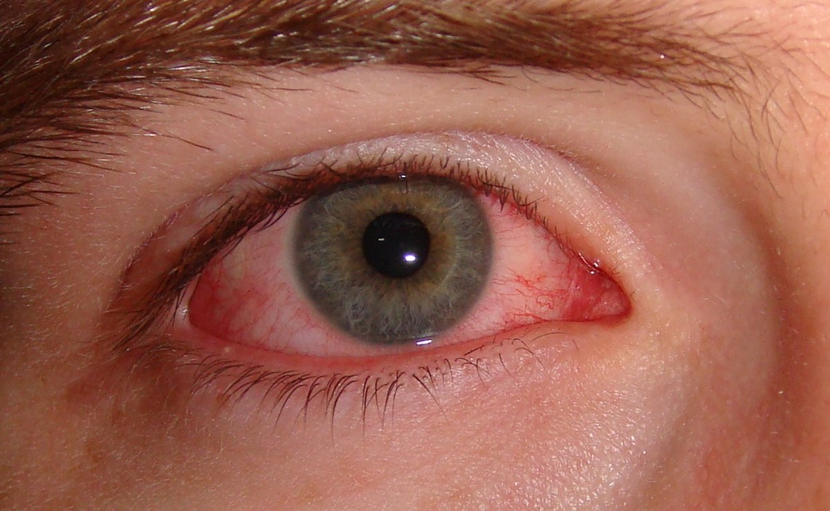 conjuntivitis en aleman