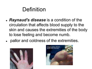 raynauds phenomenon ppt