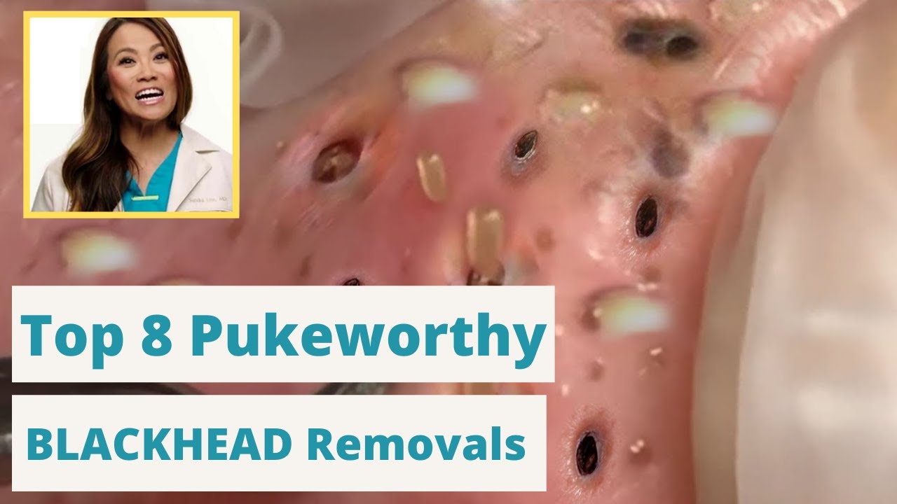 worst blackheads removal