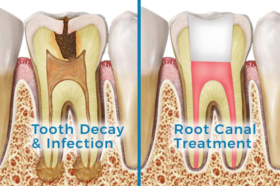 dental root canals services maple ridge