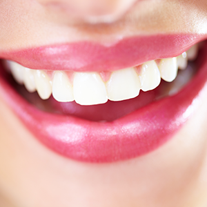 dental veneer consultation maple ridge