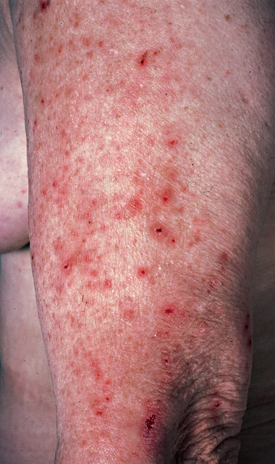 coeliac disease rash photos