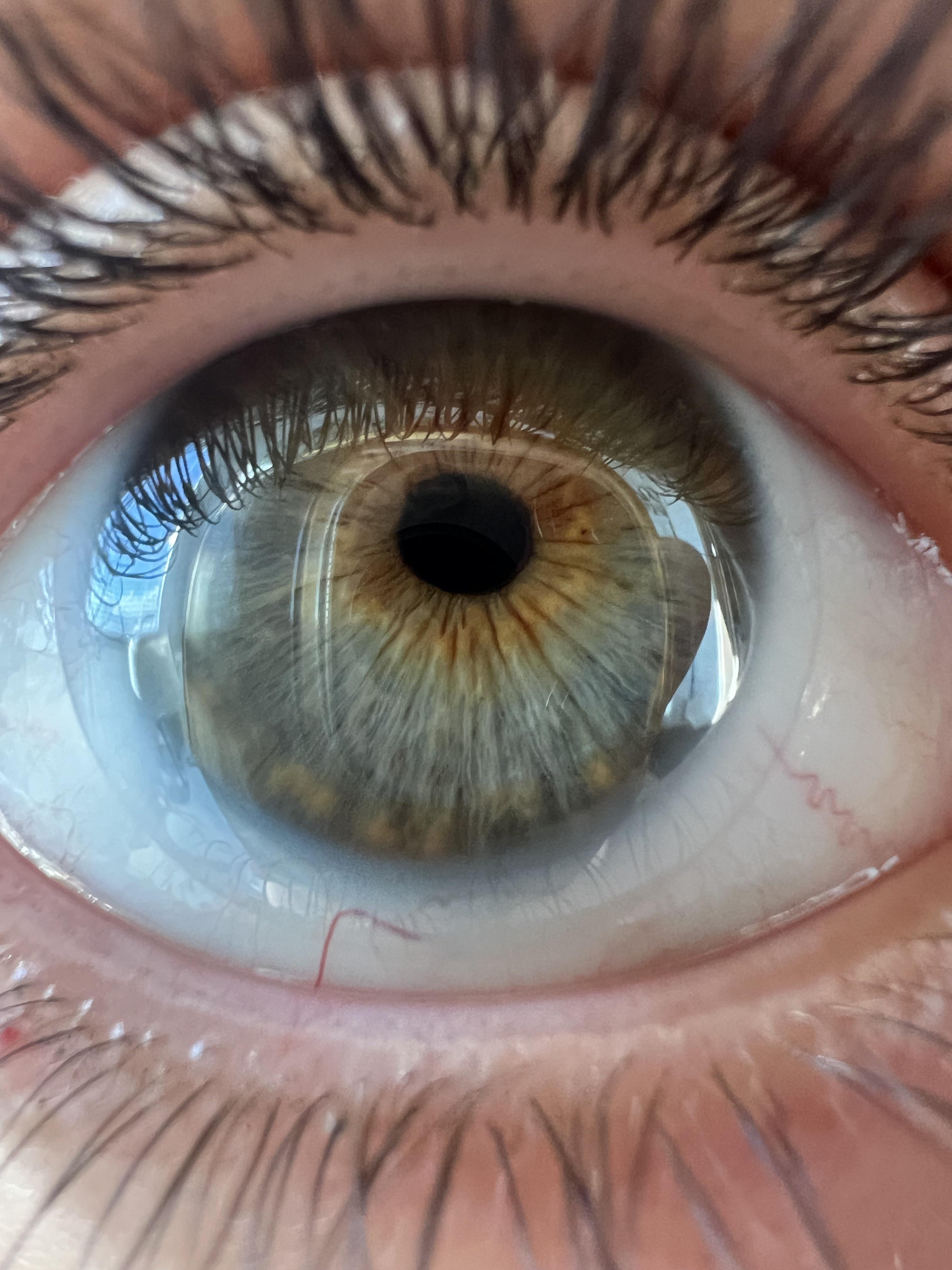 central heterochromia rarity