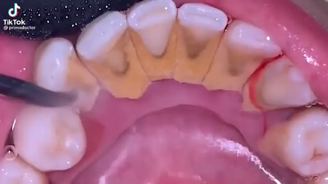 how to remove tartar from teeth without dentist reddit