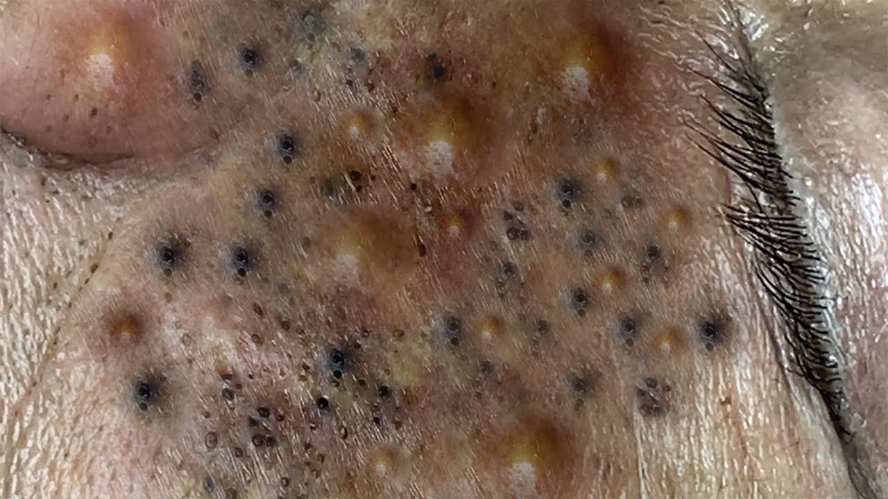 big blackheads