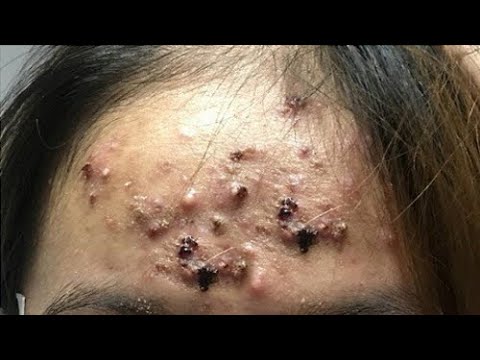 huge blackheads popped